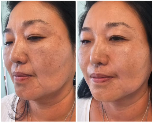 Tratamento de melasma e textura