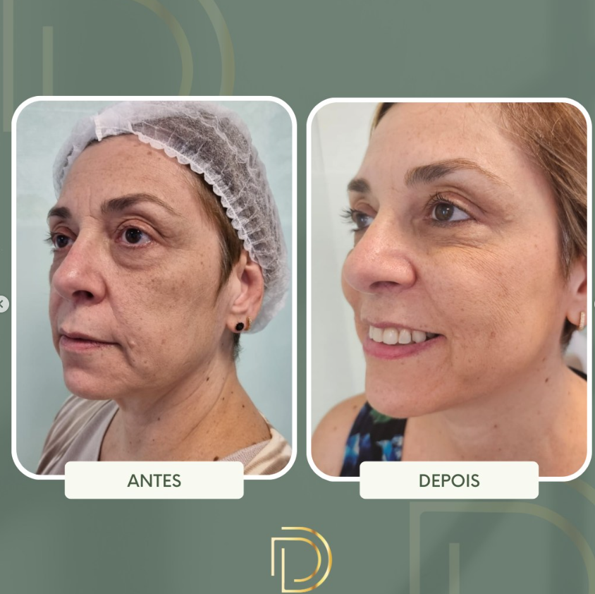 Lifting facial com fios de PDO